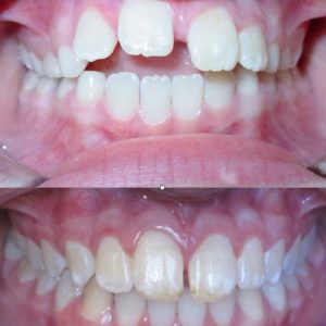 Bandeen Orthodontics Case Study #38