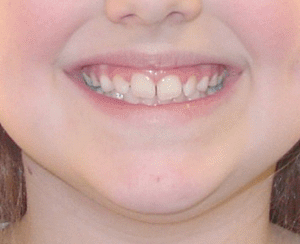 Bandeen Orthodontics Case Study #47