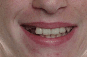 Bandeen Orthodontics Crowding - Case #39