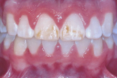 Case Study 61 – Brown Stains on teeth
