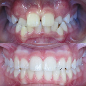 Bandeen Orthodontics Case Study #29