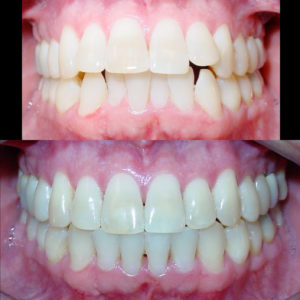 Bandeen Orthodontics Case Study #30