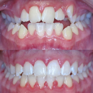 Bandeen Orthodontics Case Study #31