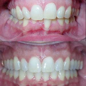 Bandeen Orthodontics Case Study #33