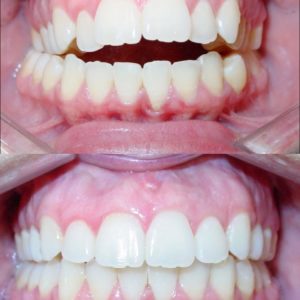 Bandeen Orthodontics Case Study #36