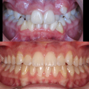 Bandeen Orthodontics Case Study #22