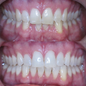 Bandeen Orthodontics Case Study #23
