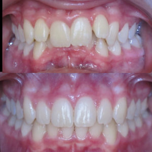 Bandeen Orthodontics Case Study #25