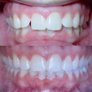 Bandeen Orthodontics Case Study # 26