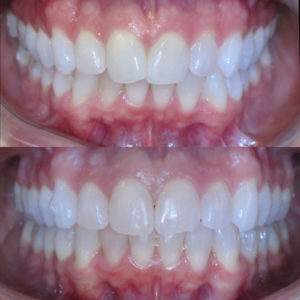 Bandeen Orthodontics Case Study #27