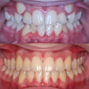 Bandeen Orthodontics Case Study #28