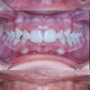 Bandeen Orthodontics Case Study 40