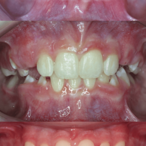 Bandeen Orthodontics Case Study #46