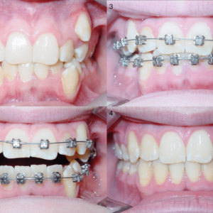 Bandeen Orthodontics Case Study #15