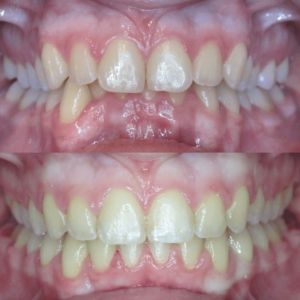 Bandeen Orthodontics Case Study #16