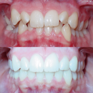 Bandeen Orthodontics Case Study #17