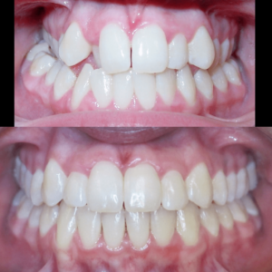 Bandeen Orthodontics Case Study #19