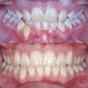 Bandeen Orthodontics Case Study #20