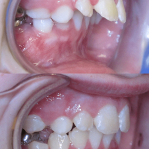 Bandeen Orthodontics Case Studies Early Treatment Frankel