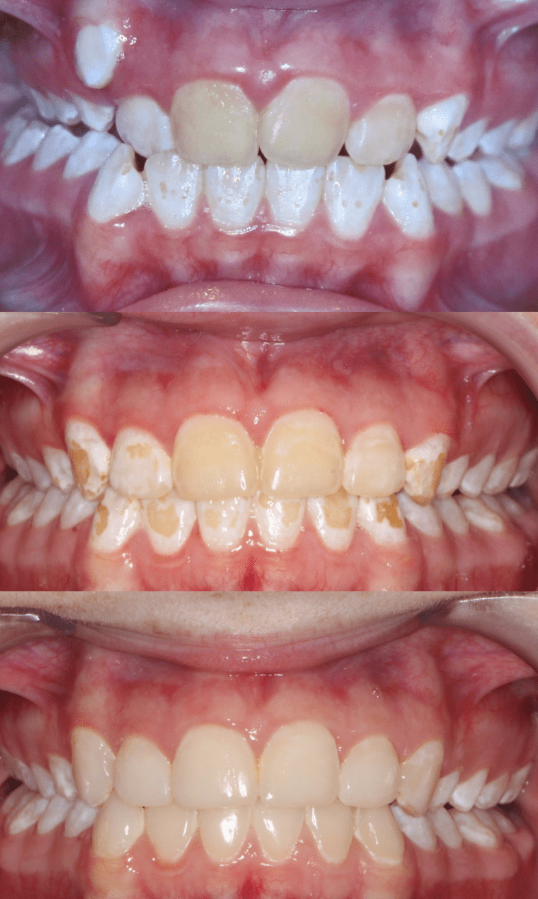 How To Get Rid Of Post Braces Stains / The Fastest Way To