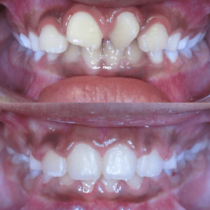 Bandeen Orthodontics Case Study #49