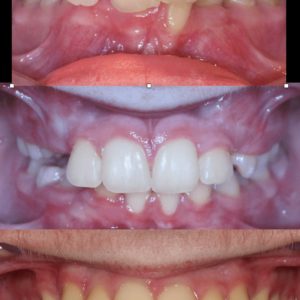 Bandeen Orthodontics Crowding Case 39