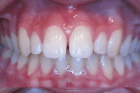 Case Study 60 – Length of teeth and ” gummy” smile