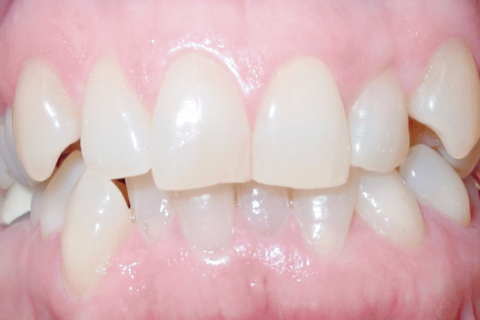Case Study 64 – Worn edges of front tooth restored