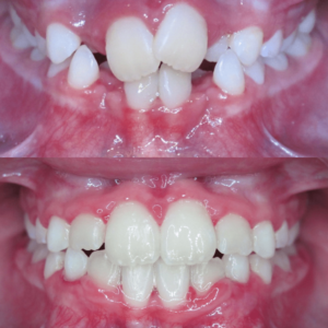 Bandeen Orthodontics Case Study #51
