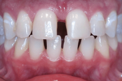 Case Study 67 – Spaces between teeth