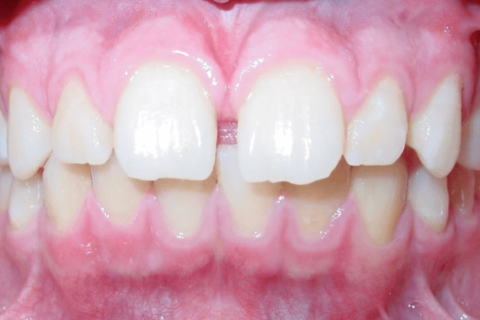 Case Study 69 – Spaces between upper front teeth (Invisalign)