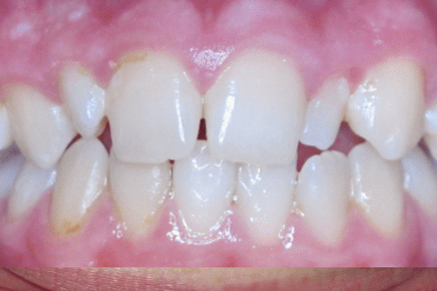 Case Study 50 – Premolar in the roof of the mouth