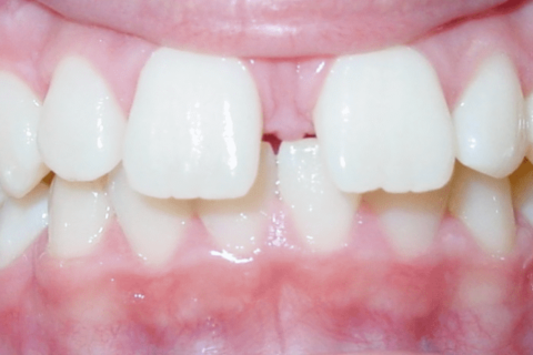 Case Study 73 – Second premolars impacted due to early loss of baby teeth