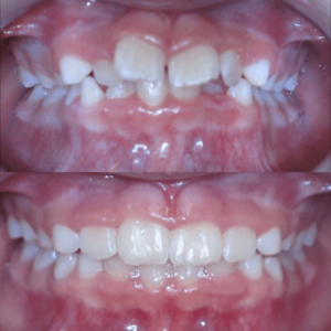 Bandeen Orthodontics Case Study #53
