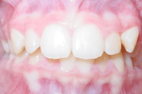 Dental Implants and Missing Teeth