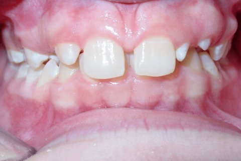 Case Study 78 – Missing upper right lateral incisor, peg upper left lateral incisor, and camouflaged the absence of both with moving the other teeth forward