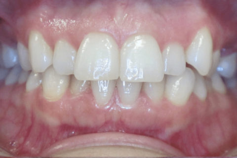 Case Study 79 – Missing upper second premolars, and camouflaged the absence of both with moving the other teeth forward