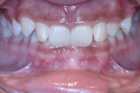 Case Study 82 – Missing a lower incisor, and camouflaged the absence of both with moving the other teeth forward