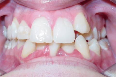 Case Study 83 – Missing a lower incisor, upper right first premolar, and upper left lateral incisor, camouflaged the absence of all three