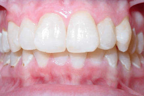 Case Study 84 – Missing a lower right first molar, and camouflaged the absence of both with moving the other teeth forward