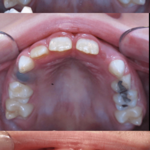 Bandeen Orthodontics Case Study # 42