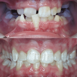 Bandeen Orthodontics Case Study #43