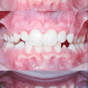 Bandeen Orthodontics Case Study #48
