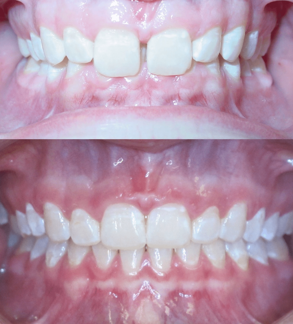 Case Study 71 - Spaces between teeth - Bandeen Orthodontics