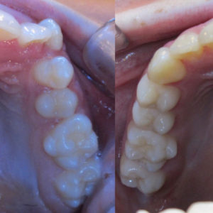 Bandeen Orthodontics Case Study #21