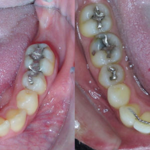 Bandeen Orthodontics Case Study #33