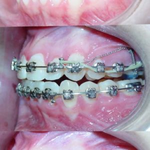 Bandeen Orthodontics Case Study #34