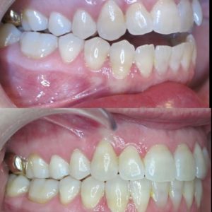 Bandeen Orthodontics Case Study #37