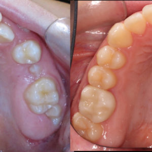 Bandeen Orthodontics Case Study #22