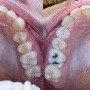 Bandeen Orthodontics Case Study #24